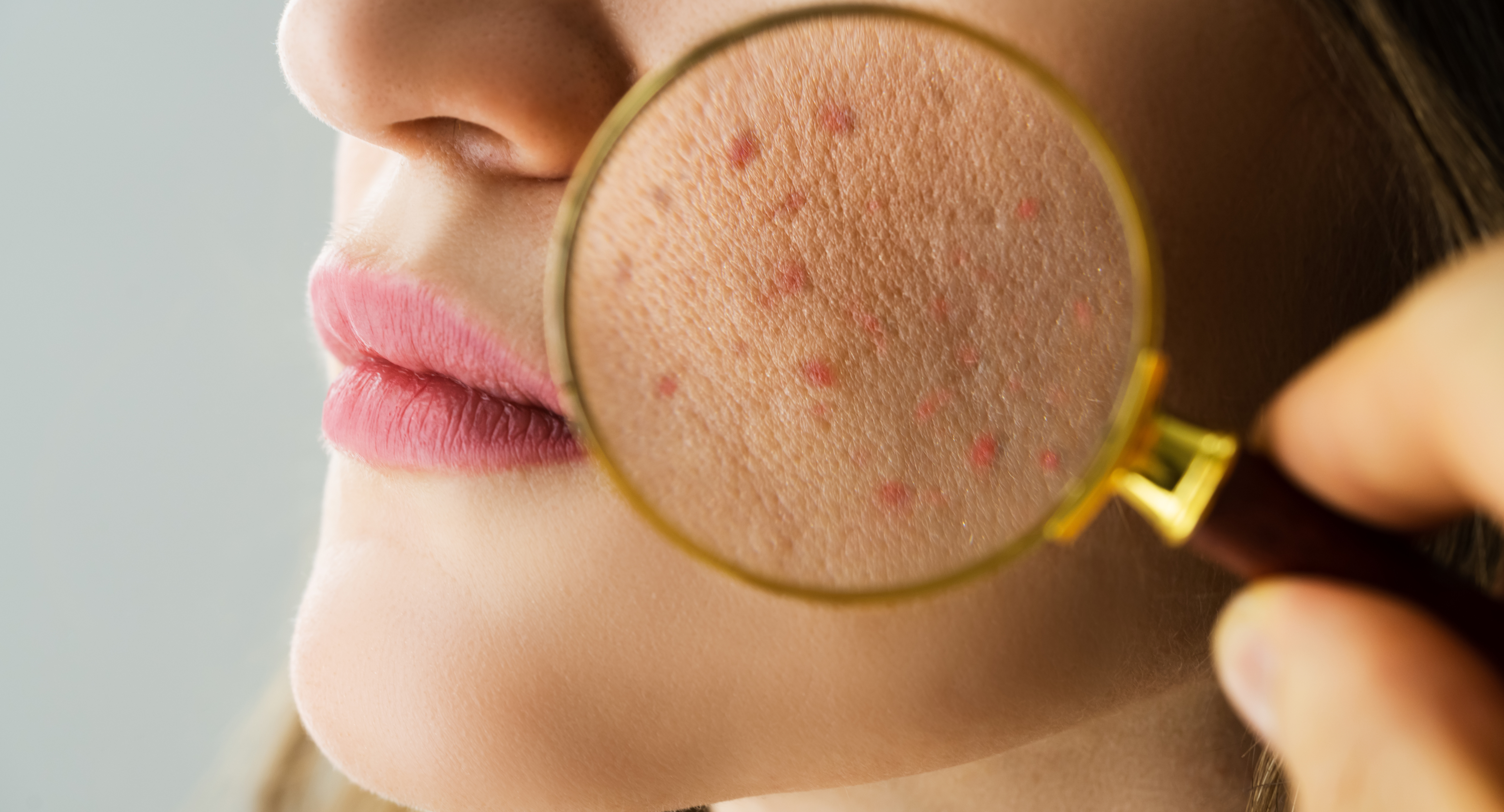 Suffering From Acne Breakouts? Here Are Our Treatment Secrets