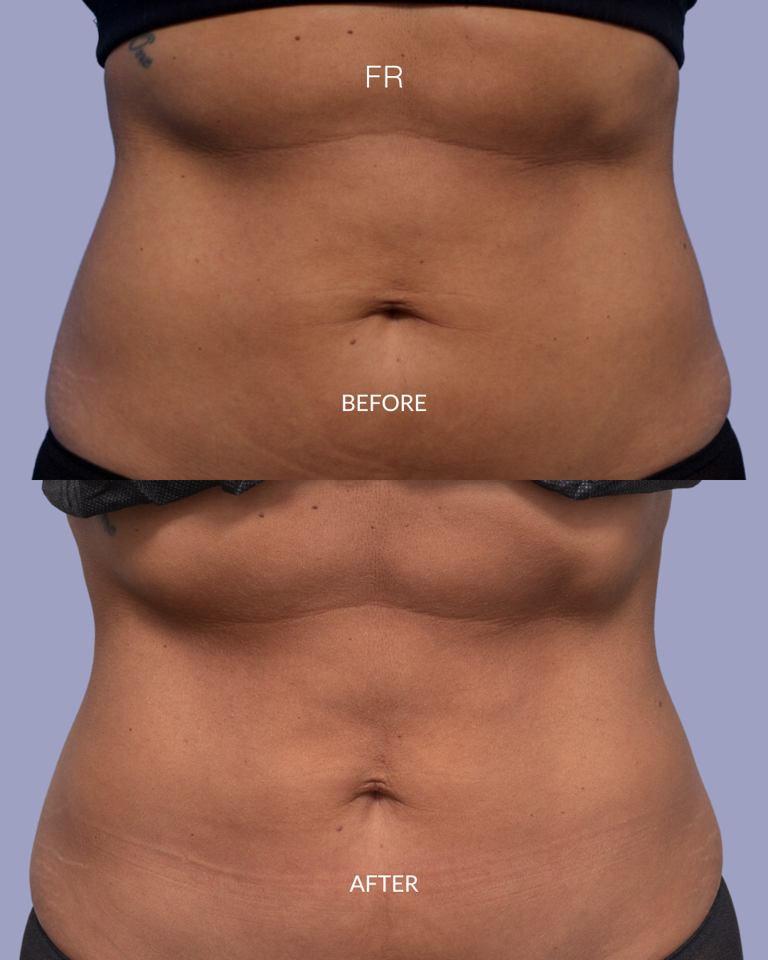 6 cycles of truSculpt on their upper and lower abdomen, followed by 1 session of Flex. 