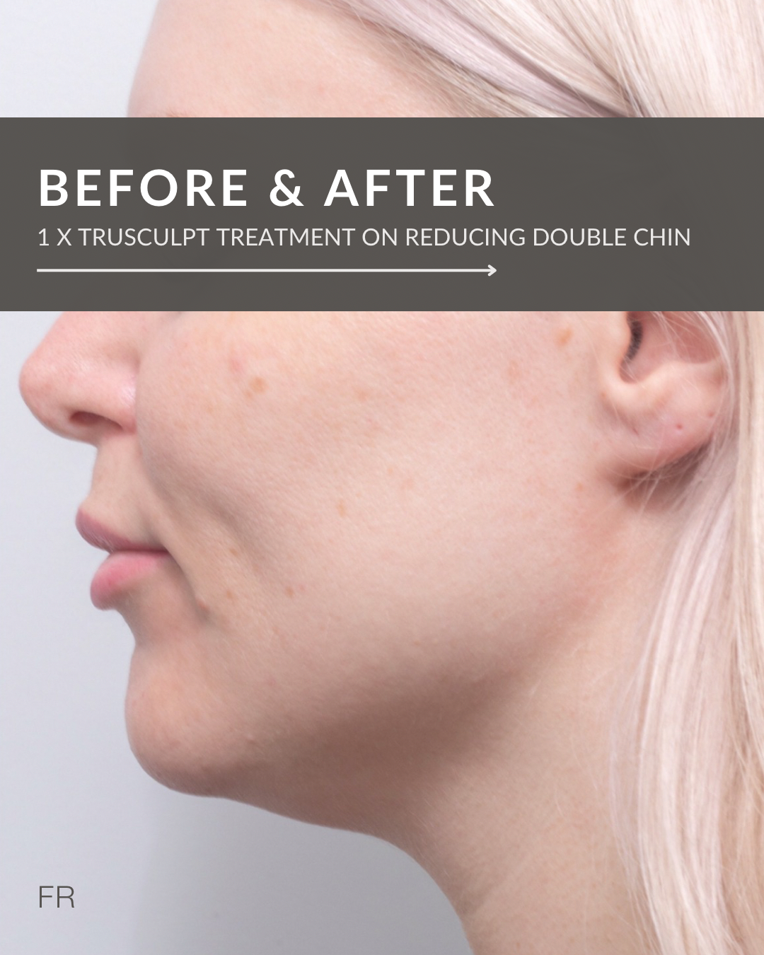 truSculpt on chin fat pocket at Flawless Rejuvenation