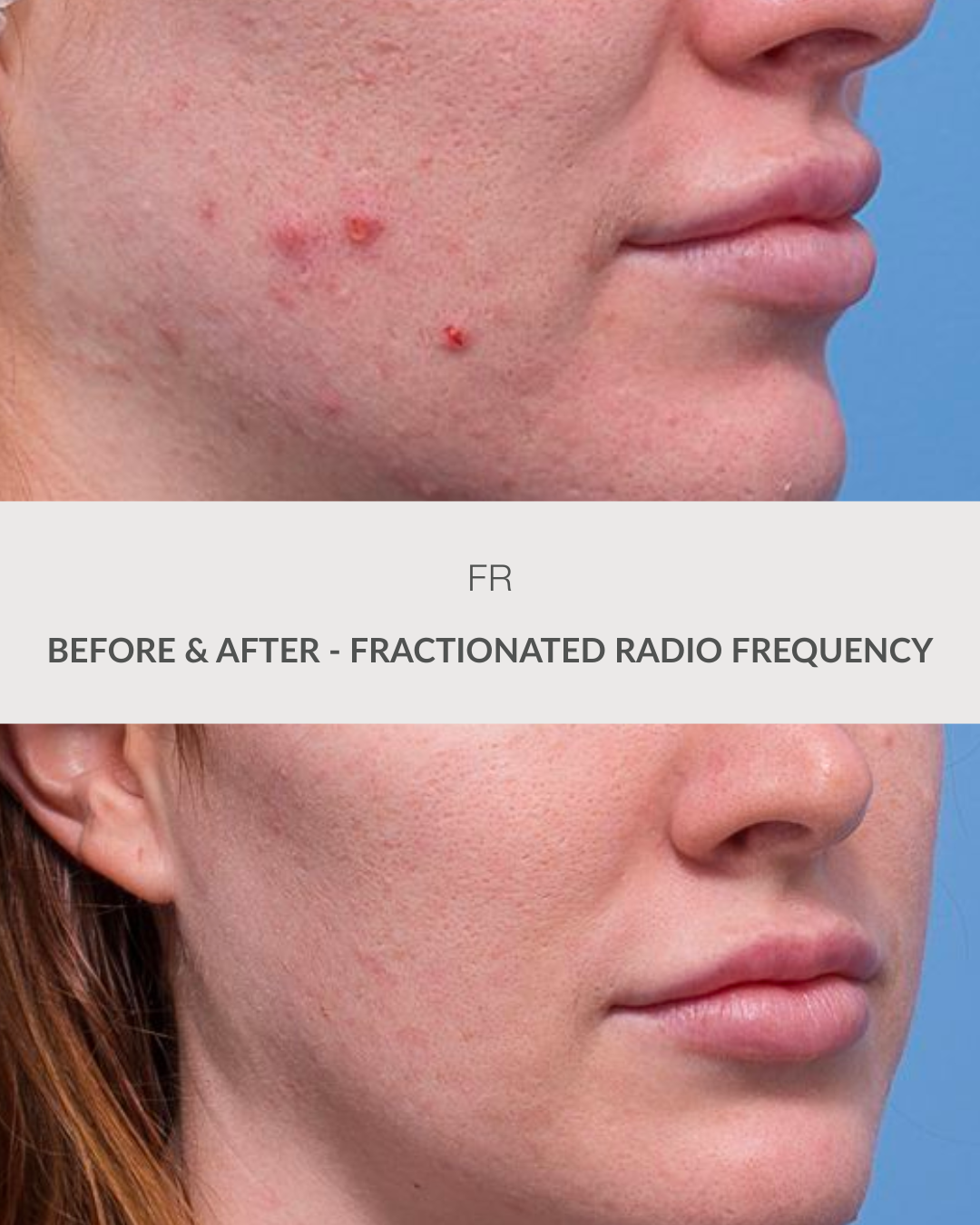 Venus Viva Before & After at Flawless Rejuvenation