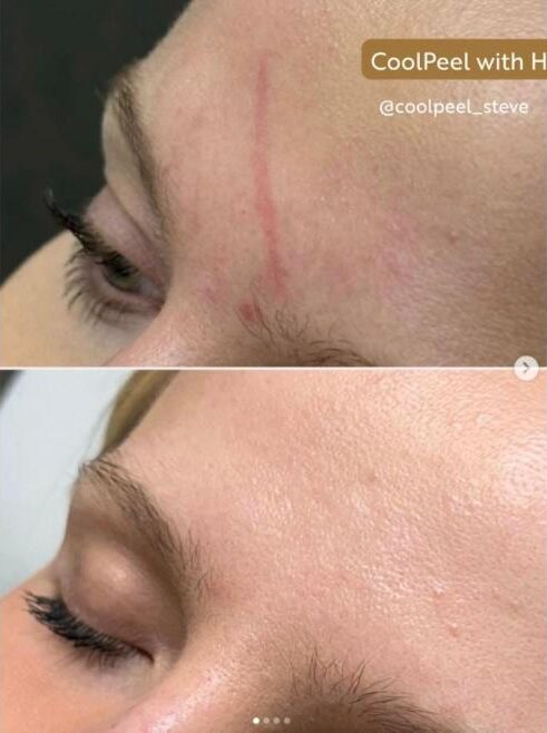 CoolPeel before and after: Forehead and fine lines
