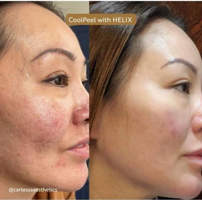 CoolPeel before and after: Skin tone and texture